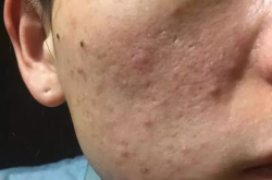 痤瘡的治療方法,綜合療法，告別青春痘困擾