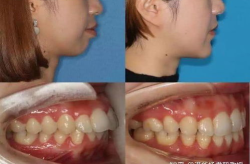 做過正頜手術(shù)的明星,揭秘正頜手術(shù)的神奇魅力